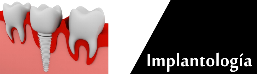 Implantes Dentales Implantología Clínica Rull