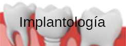 Implantes dentales Implantología Clínica Rull