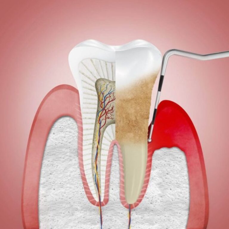 endodoncia