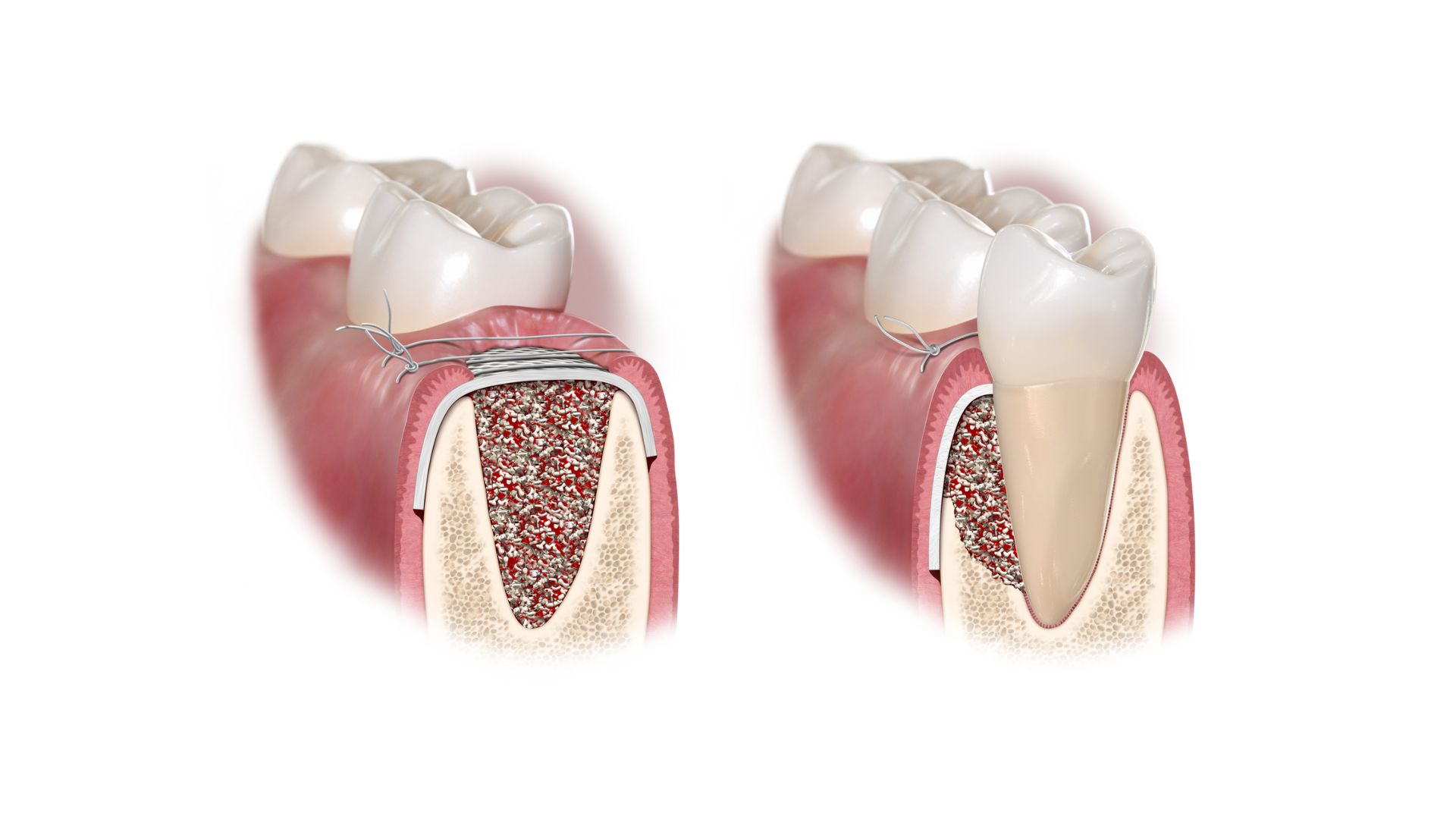 regeneración ósea clínica Rull